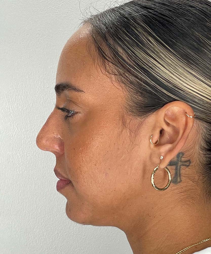 Rhinoplasty Before & After Image